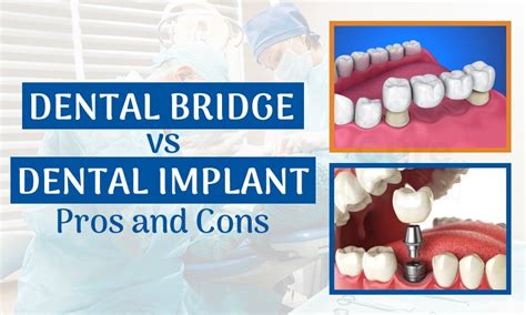 Dental Bridge Vs Implant Pros And Cons You Want To Know
