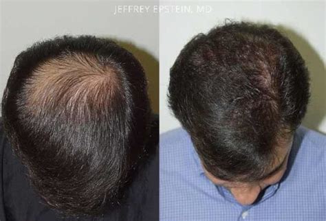 Hair Transplants For Men Photos Miami Fl Patient