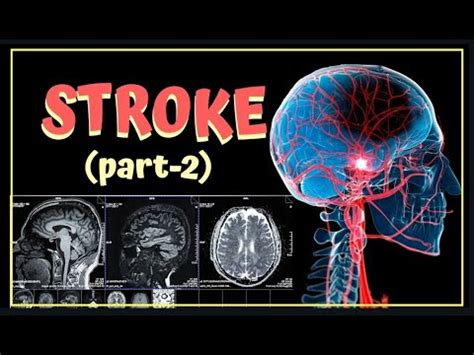 Stroke Part Evaluation Of Stroke Youtube