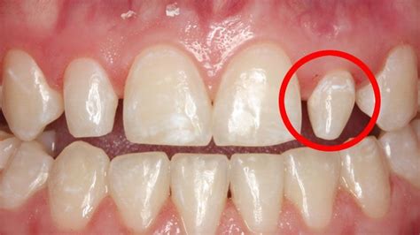 What Are Peg Teeth In 2020 Wisdom Teeth Teeth Shape Teeth