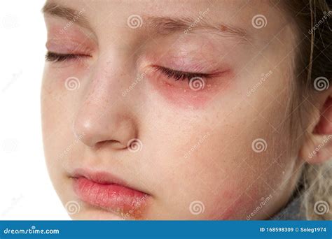 Allergic Reaction Skin Rash Close View Portrait Of A Girl`s Face