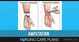 Nursing Management Of Amputation Images