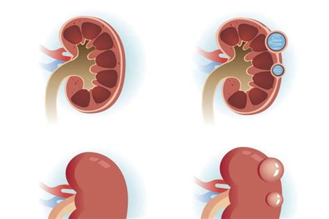 Understanding Kidney Cysts Causes And Non Invasive Treatment Options