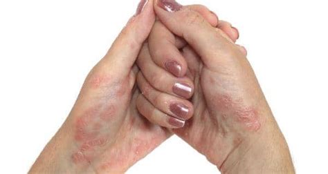7 Tips To Prevent A Flare Up Of Psoriatic Skin Symptoms