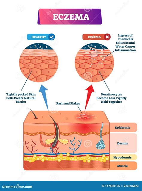 Eczema Vector Illustration Labeled Anatomical Structure Comparative