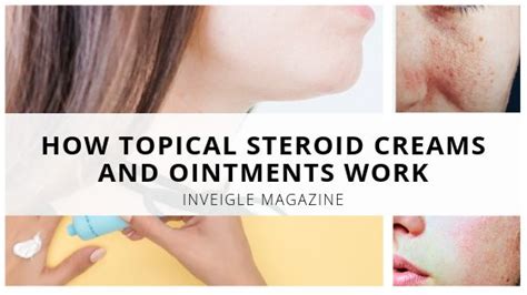 How Topical Steroid Creams And Ointments Work Healthtips Health