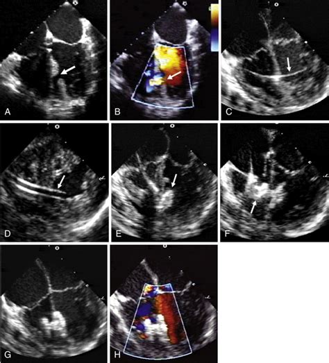 Percutaneous Closure Of Congenital Acquired And Postinfarction