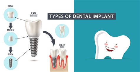 Types Of Dental Implant