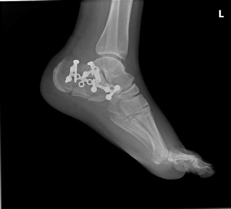 Fractured Heel Bone Need Surgery Heres How Orthopaedic Foot And