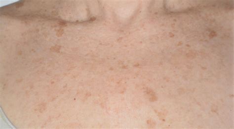 Seborrheic Keratosis Pure Dermatology