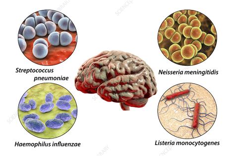Causes Of Bacterial Meningitis Illustration Stock Image F0304309