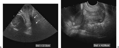 Ultrasound Evaluation Of The Cervix Radiology Key Ultrasound
