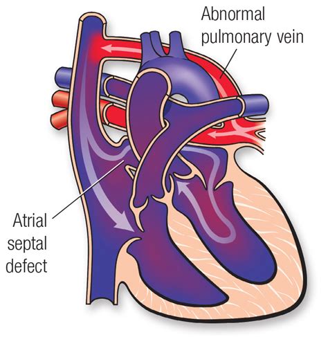 Total Anomalous Pulmonary Venous Connection (TAPVC) | American Heart ...