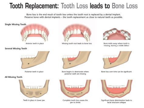 Jaw Bone After Tooth Extraction