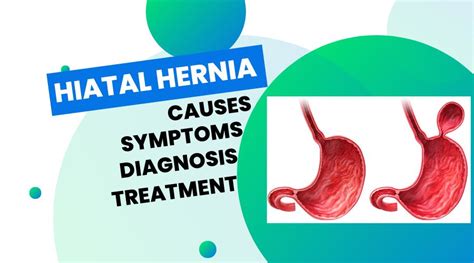 Hiatal Hernia Causes Symptoms Diagnosis Treatment Chiropractor