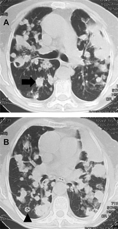 Scielo Brasil Multiple Pulmonary Nodules Caused By Corynebacterium