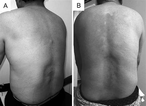 Figure1skin Appearance In Patient 1 A And Patient 2 B Artificial