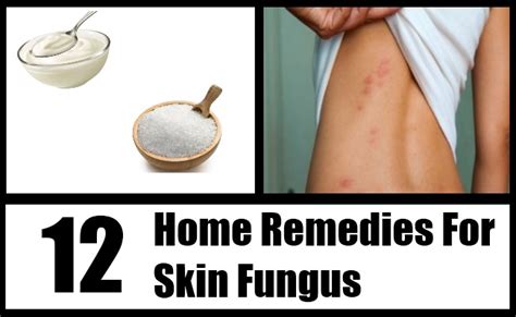 12 Skin Fungus Home Remedies Natural Treatments And Cures Search