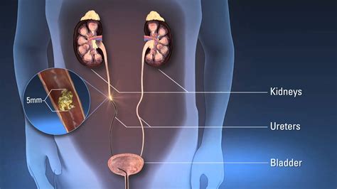 Kidney Stone Removal Ureteroscopy Male Kidneyoi
