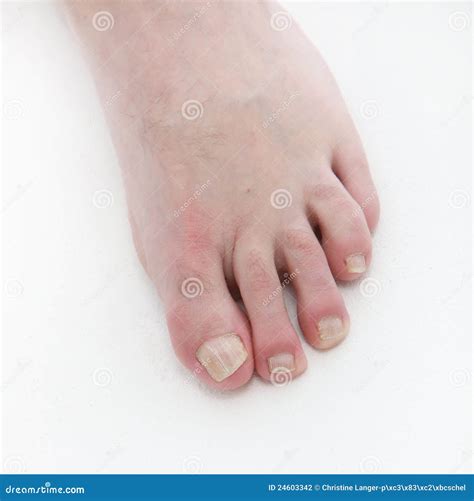 Psoriasis Under The Toenails Close Up Stock Photo Image Of Itching