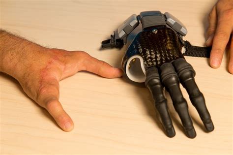 Active Advanced Prosthetic Hand At Rs Unit Artificial Limbs