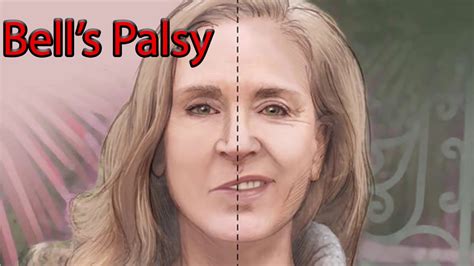 A stroke, on the other hand, is a medical emergency. Bell's Palsy - Facial Nerve palsy - YouTube