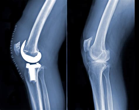 Total Knee Replacement For Osteoarthritis Benefits And Cost Effectiveness