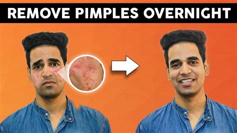 How To Remove Pimples Marks From Face For Men 2020 Youtube