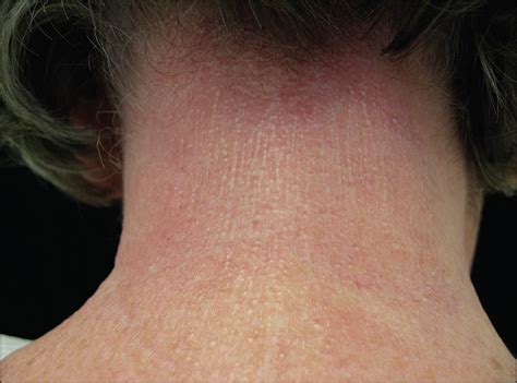 diffuse skin thickening and linear papules in a 59 year old woman—quiz case dermatology jama
