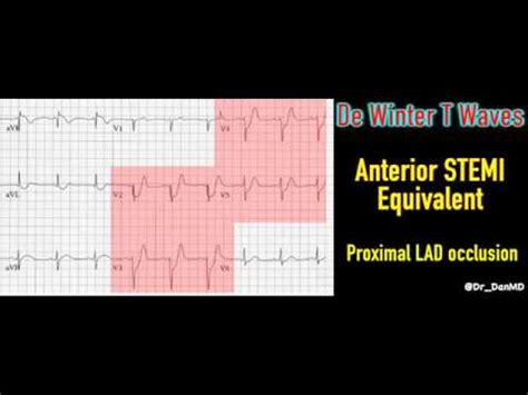 Diagnostic criteria for dewinter t waves. De Winter T Wave - YouTube