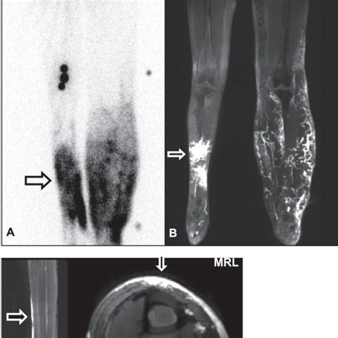 Woman Age 48 Years With Bilateral Lymphoedema A Lymphoscintigraphy