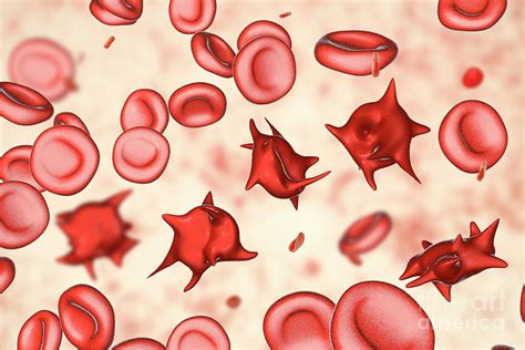 Acanthocyte Abnormal Red Blood Cells Photograph By Kateryna Konscience