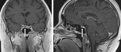 Severe Corticotropin Dependent Cushing Syndrome From A Pituitary
