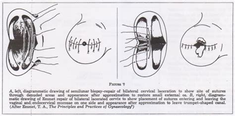 Calvin Midgley Cervical Repair