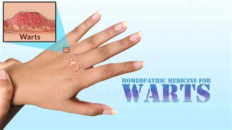 Homeopathic Medicine For Warts Homeopathic Medicine 4 All Disease