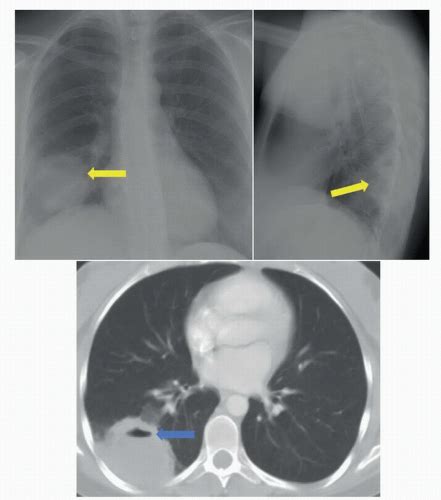 Lung Abscess Ct Scan