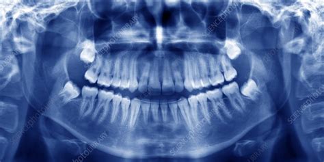 Wisdom Teeth Eruption Panoral X Ray Stock Image C0131068