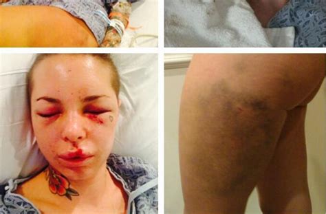 Christy Mack Posts Disturbing Photos From Alleged War Machine Assault