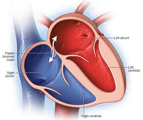 Patent Foramen Ovale Causes Symptoms Diagnosis Treatment