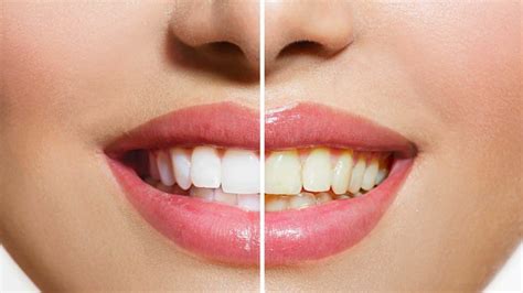 Guide On Best Teeth Whitening Products Skingroom