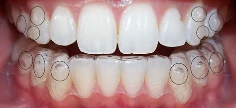 Invisalign Glass Attachments Invisalign Attachments Invisalign Dentist