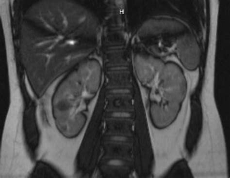 Mri Coronal View Angiomyolipomas Or Hamartomas Of Tuberous Sclerosis In
