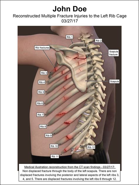 Rib Cage Fractures Illustration By Visuals For Law Medical