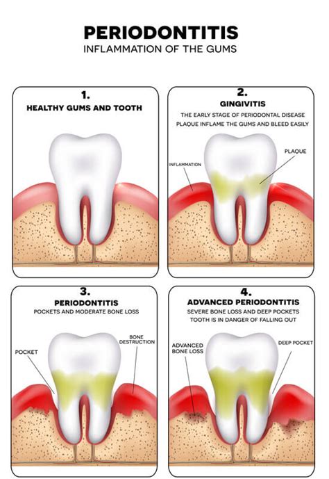 How To Cure Gingivitis In A Week At Home 5 Effective Ways