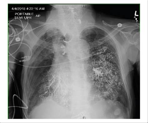 Bilateral Middle And Lower Lobes Of The Lung Showing Barium Sulfate