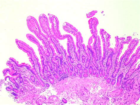 An Approach To Duodenal Biopsies Journal Of Clinical Pathology