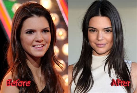 Kendall Jenners Plastic Surgery Procedures