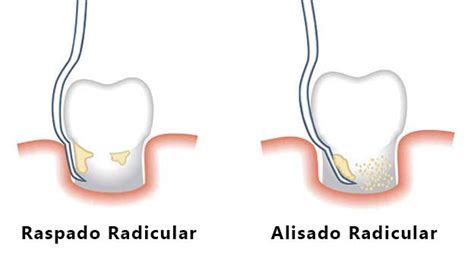 Curetaje Dental Raspado Y Alisado Radicular En Zaragoza