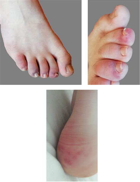 Chilblain‐like Lesions On Feet And Hands During The Covid‐19 Pandemic