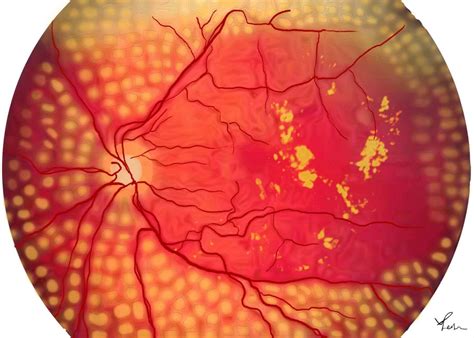 Panretinal Photocoagulation Laser Prp